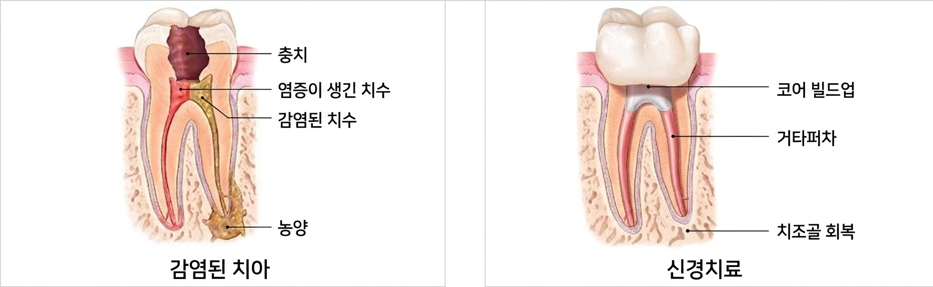 신경치료 후 크라운이 필요한 이유. 앞니와 어금니 완전 분석