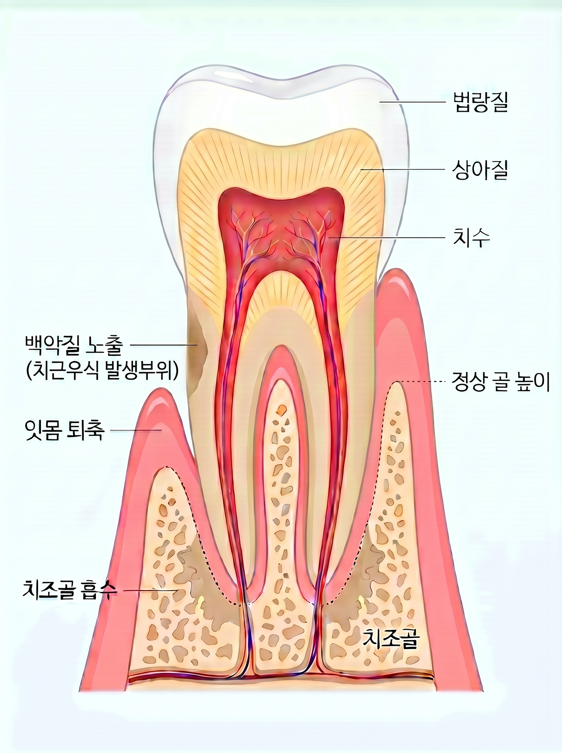치근 우식이 발생하는 부위