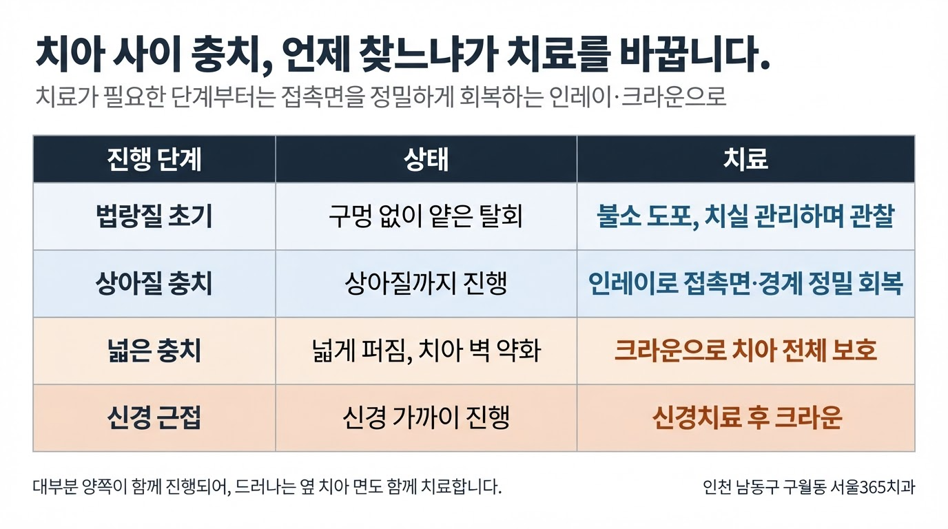 치아 사이 충치, 왜 늦게 발견될까 — 신호와 치료